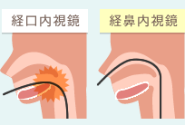 経口内視鏡と経鼻内視鏡の違い