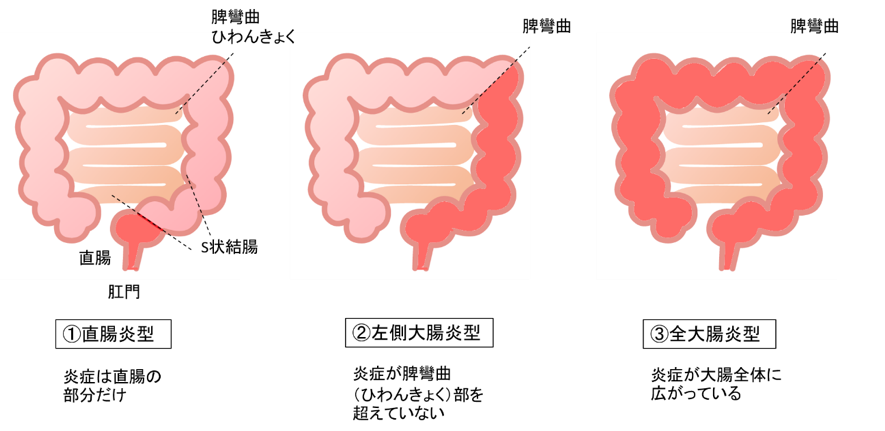 重症 炎 性 潰瘍 度 大腸