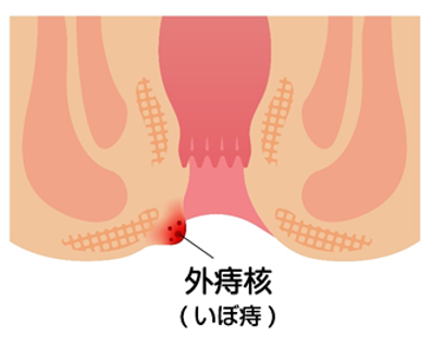 血便 痔の治療について 春日井市のさかきばらクリニック